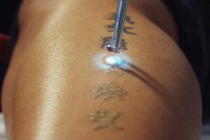 Dolor por eliminación de tatuajes con láser: ¿cuánto duele?