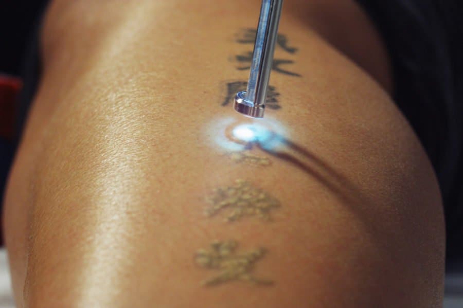 lasering tattoo
