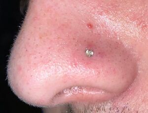 Perforación de la nariz hundida en el agujero: ¿¡Qué está pasando!?