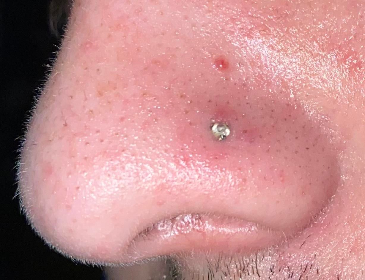 nose piercing sinking into hole