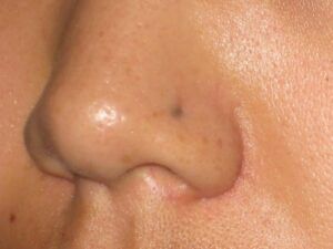 Qué hacer con la piel que crece sobre un piercing en la nariz