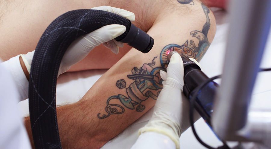 tattoo being removed