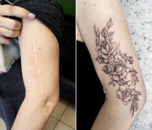 ¿Se puede hacer un tatuaje sobre una cicatriz?
