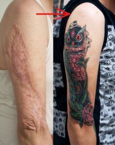 ¿Se puede hacer un tatuaje sobre una cicatriz de quemadura?
