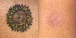 ¿La eliminación de tatuajes dejará una cicatriz?