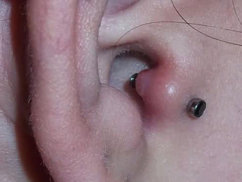 tragus piercing swelling 2