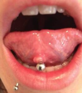 Bultos duros alrededor de un piercing en la lengua