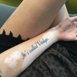 Vitíligo y tatuajes: todo lo que necesitas saber