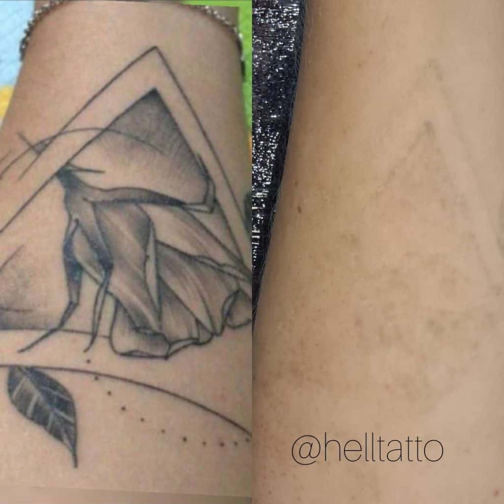 eliminación de tatuajes antes y después